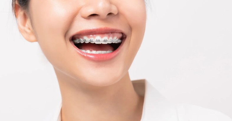 стоимость брекет систем стоимость брекет систем